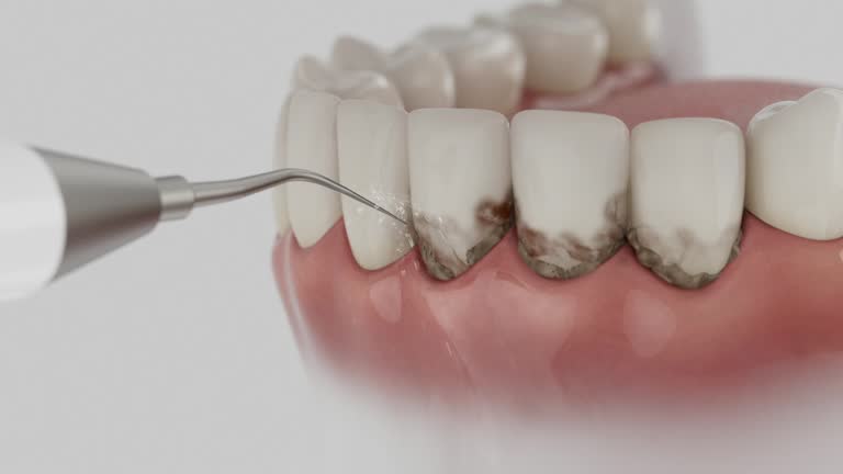 Trusted Wisdom Tooth Removal service in Vero Lake Estates, FL - Dentist Open Now
